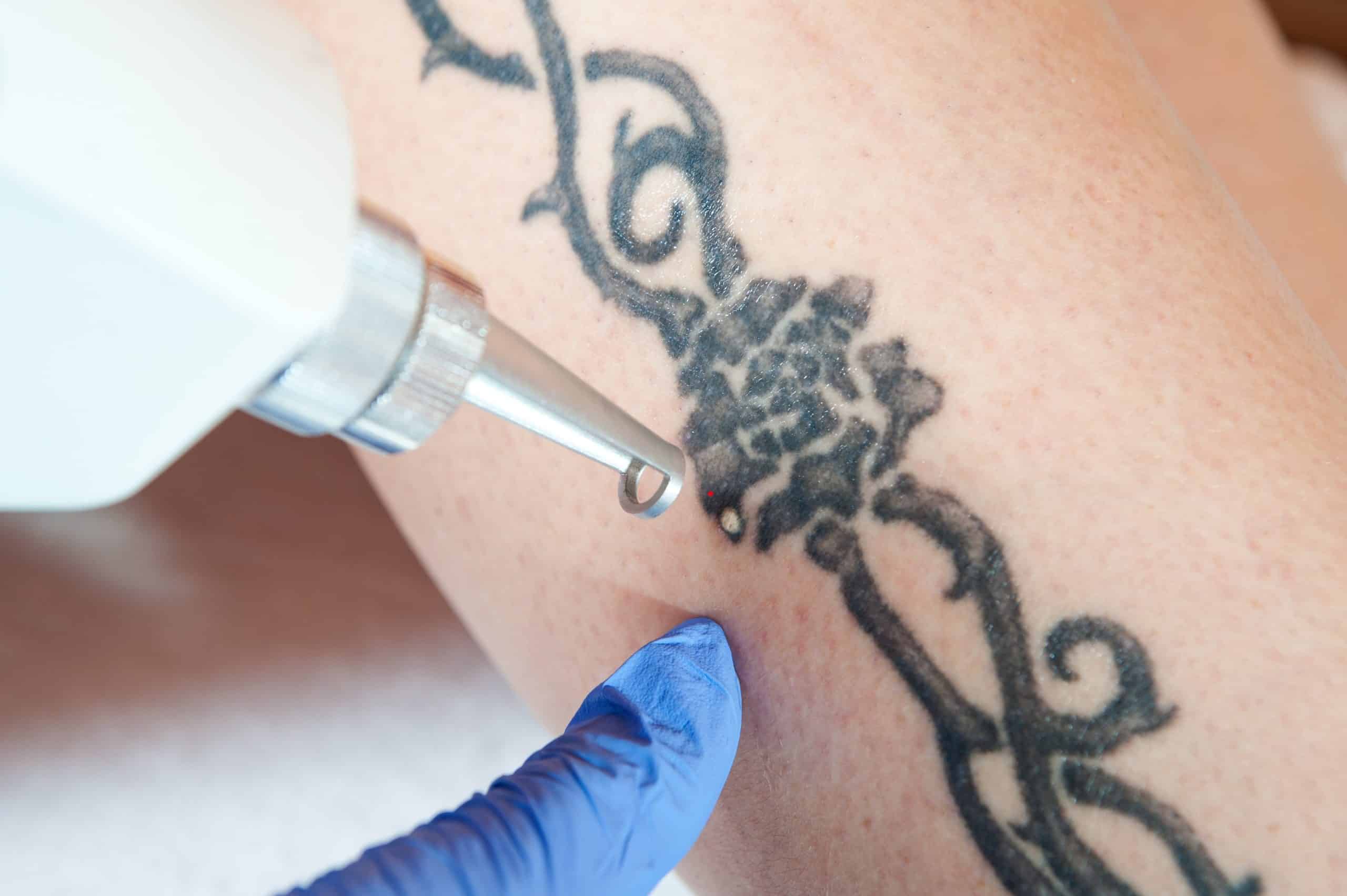 Ist eine Tattooentfernung schmerzhaft?